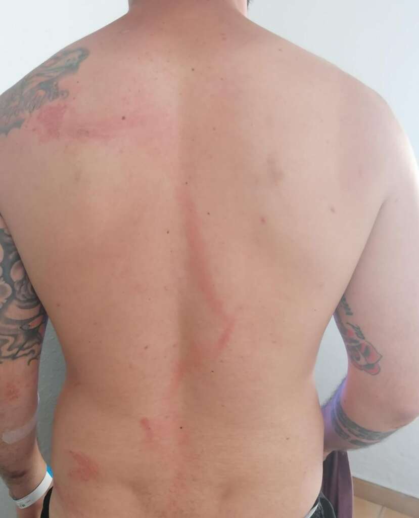 Descripción de la imagen: fotografía de la espalda de un chico con una cicatriz producida por el impacto de un rayo por toda la espalda 